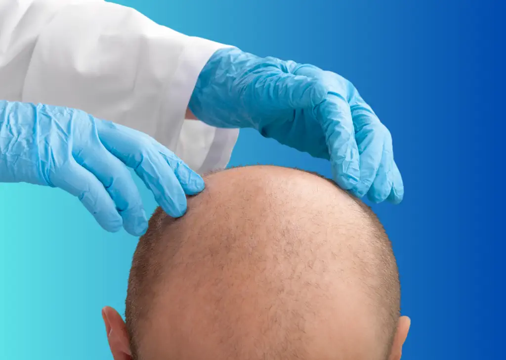 What is DHI Hair Transplantation?